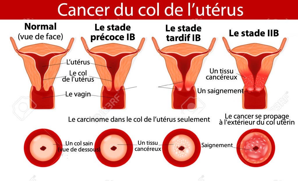 5-types-courants-de-cancer-et-leurs-symptômes-que-vous-devez-connaitre3