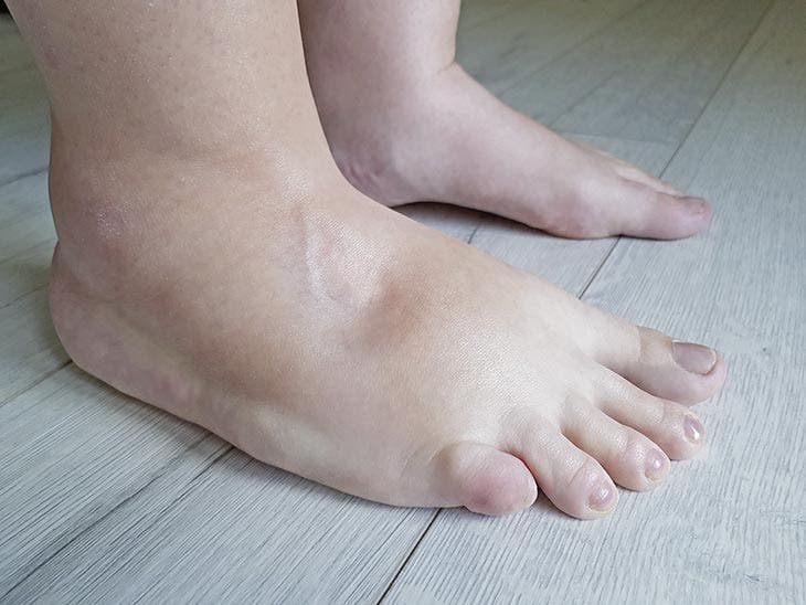 Des pieds gonflés