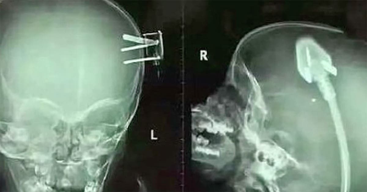 Le scanner du cerveau d’un garçon choquent les médecins du monde entier