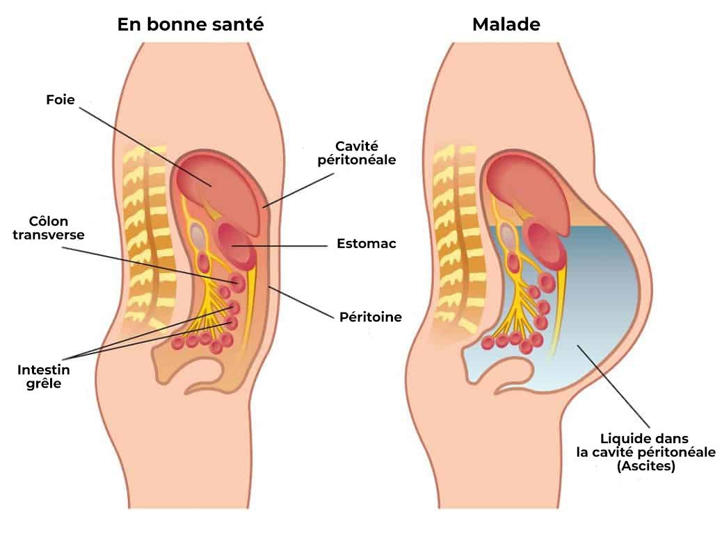 cancer du foie