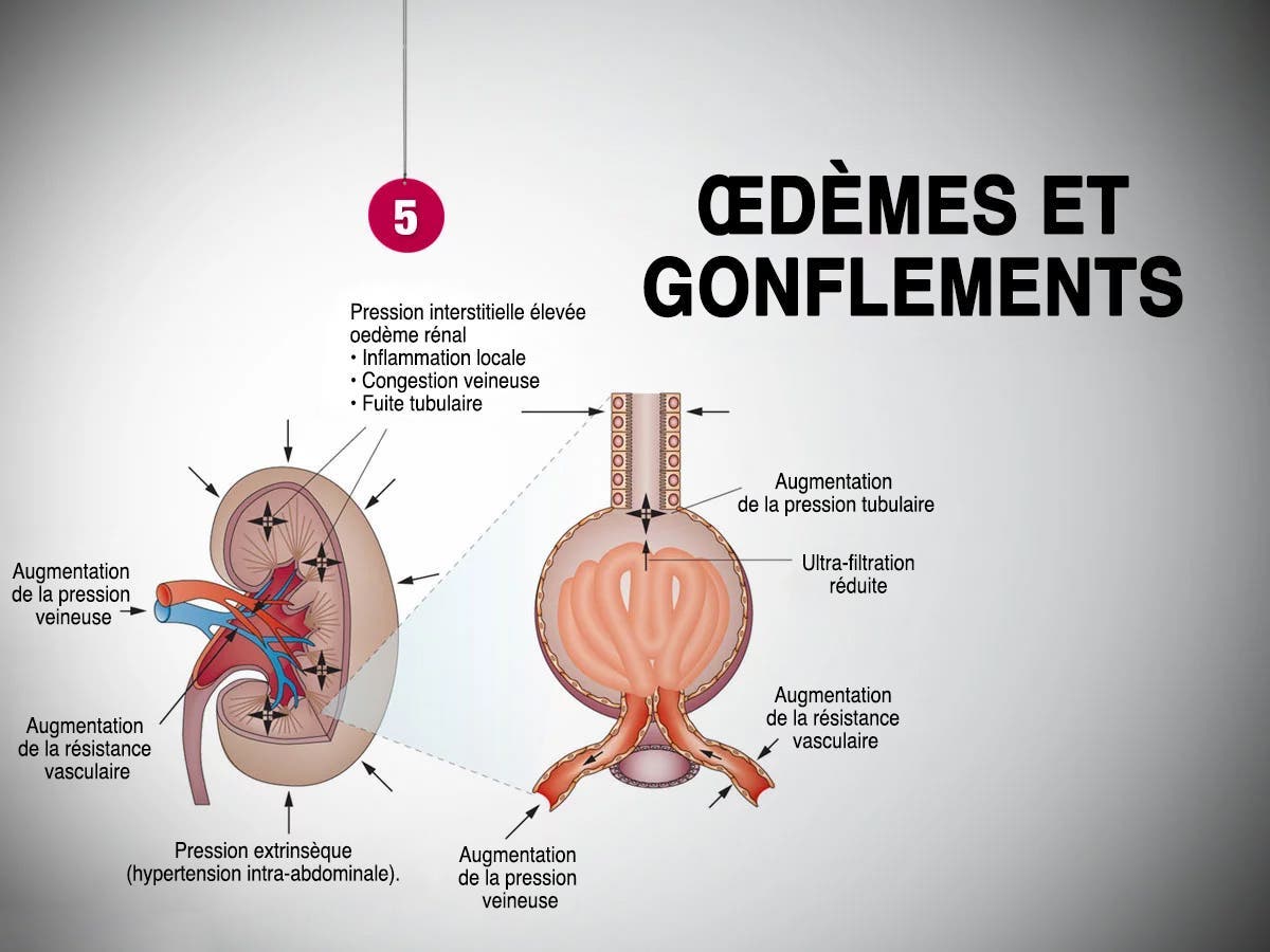 Œdèmes et gonflements