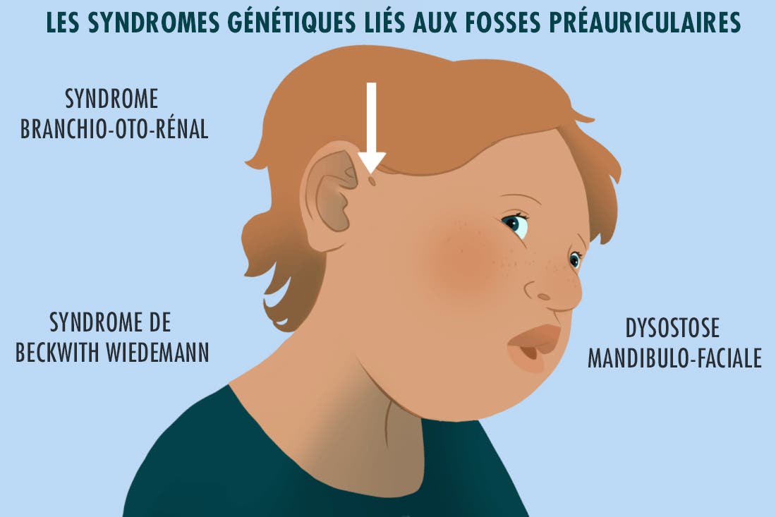 Les syndromes qui peuvent accompagner les fosses préauriculaires 